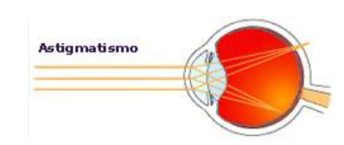 astigmatismo3