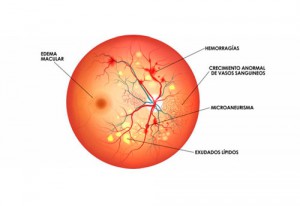 retinopatia